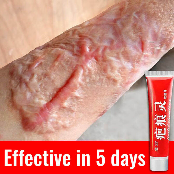 100 Effective scar remover Scar removal for old scars all body fades