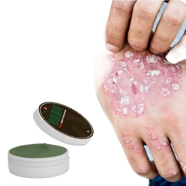 【Spot goods】 BRIM Scabies Ointment scabies treatment for human scabies