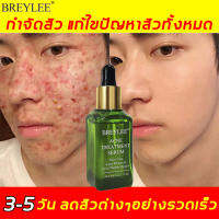 ผลดีมาก！BREYLEE ครีมแต้มสิว 17ml ลดสิวต่างๆอย่างรวดเร็ว ลดรอยแผลเป็นจากสิว ให้ผิวสวยกลับมา เซรั่มรักษาสิว ครีมลดสิว ครีมลดรอยสิว ครีมแต้มสิว บำรุงผิวหน้า เจลรักษาสิว ครีมกำจัดสิว เจลแต้มสิว สิวอุดตัน สิวผด ลบรอยสิว ครีมลบลอยแผลเป็น สิวอักเสบ เซรั่มลดสิว