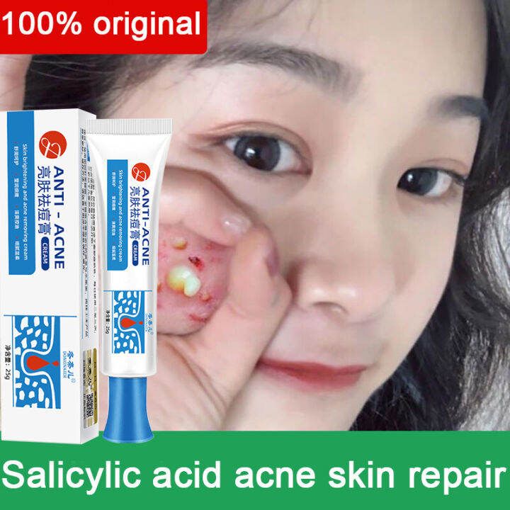 acne cream acne cleanser Remover Acne Treatment Gel remover anti