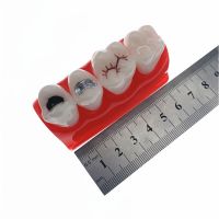 Dental Study Model For Pit And Fissure Sealing Treatment Teeth Model