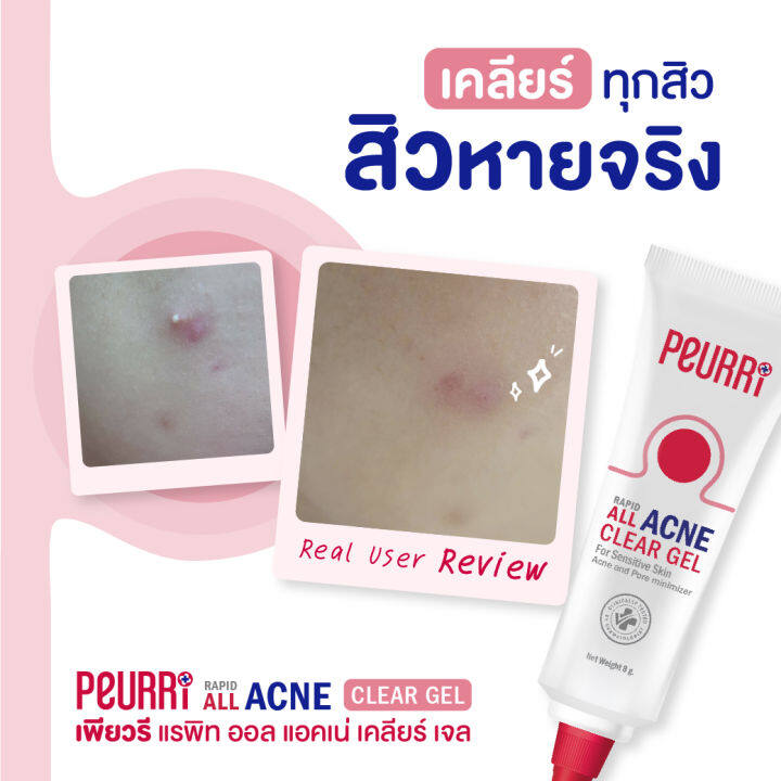 เจลแต้มสิว-peurri-all-acne-clear-gel-เพียวรี-แรพิท-ออล-แอคเน่-เคลียร์-เจล-3-หลอด