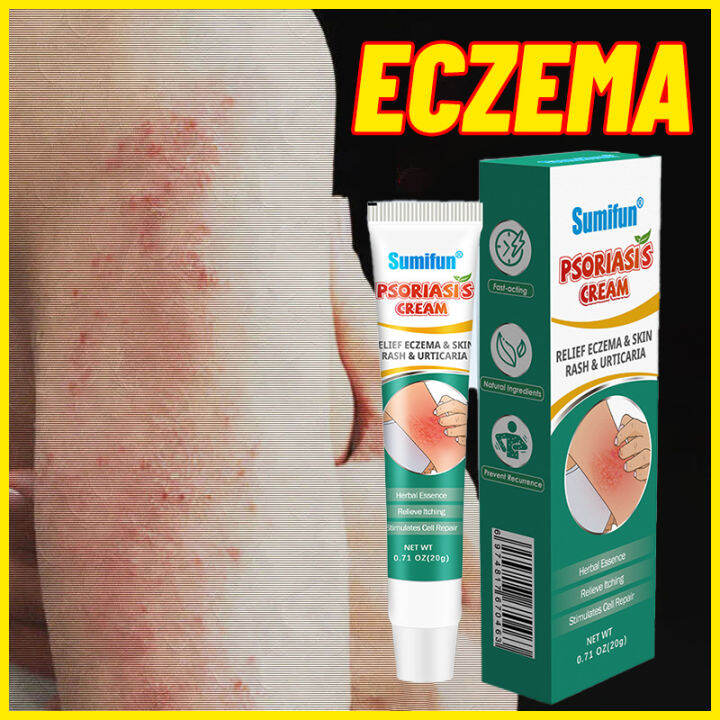 Eczema Psoriasis Cream Treatment Itchy Skin Ointment Antibacterial