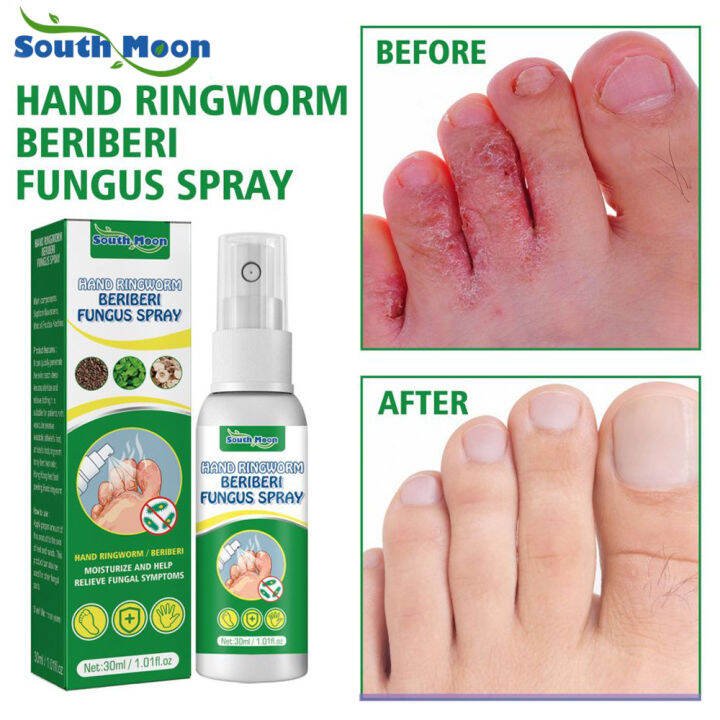 Jaysuing Anti Fungal Athlete Foot Spray Herbal Anti Fungal foot spray ...