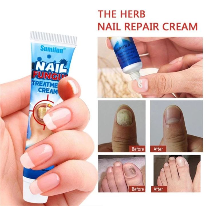 Nail Fungus Treatment Cream Sumifun ORIGINAL Onychomycosis removal ...