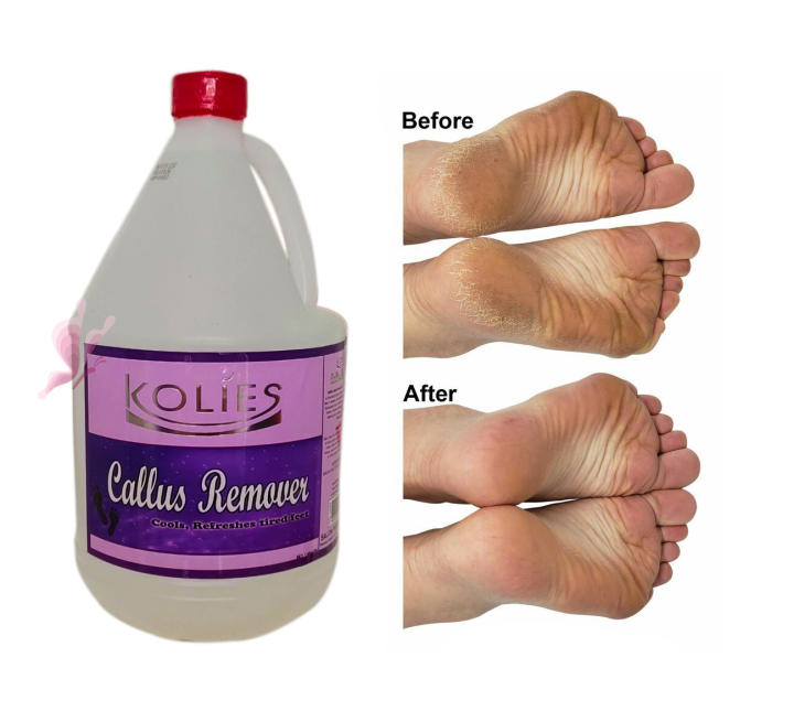 Callus Remover 1 Galon Lazada PH