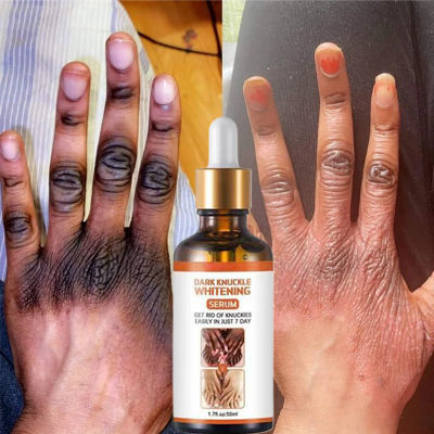 50Ml 7วัน Nicotinamide Black Fingers Remover Nicotinamide กำจัด Dark Knuckle Whitening Serum Brighten Hand Kn