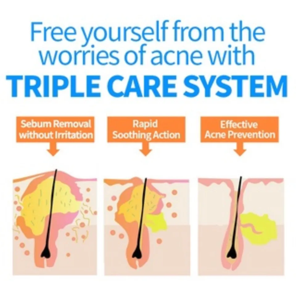 How to Get Rid of Scalp Acne in 2025: A Clear, Step‐by‐Step Plan