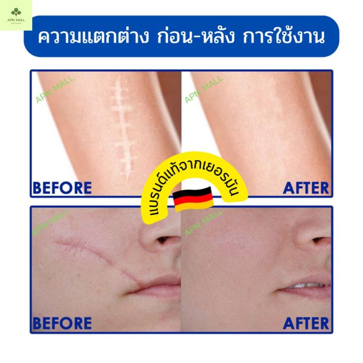 ของแท้จากเยอรมัน-พร้อมส่ง-ครีมลดรอยแผลเป็น-ลดรอยแผลเป็น-รอยสิว-ลบรอยแผลเป็น-สำหรับรอยสิว-แผลเผาไหม้-แผลเป็นจากการผ่าตัด