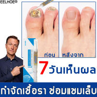 EELHOE เซรั่มบำรุงเล็บ ป้องกันเชื้อรา แก้ไขปัญหา​เล็บ​หนาที่ก่อตัวนานจากเชื้อรา เซรั่มซ่อมเซมเล็บ ครีมบำรุงเล็บ