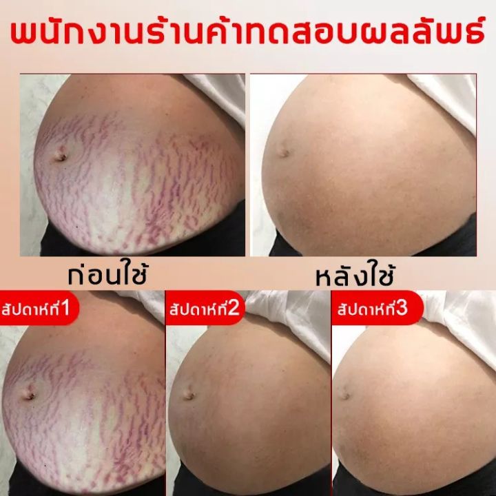 พร้อมส่ง-ใช้ได้ทั้งรอยแตกลายใหม่และเก่า-ครีมรอยแตกลาย-ครีมลอยแตกลาย-ครีมทาแตกลาย-ครีมแก้แตกลาย-ครีมทาท้องลาย-ครีมทาขาแตกลาย-ครีมลดรอยแตก-ครีมทารอยแตกลาย