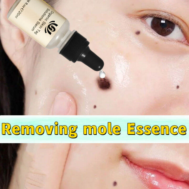 ready stock buang tahi lalat mole remover tahi lalat remover wart mole