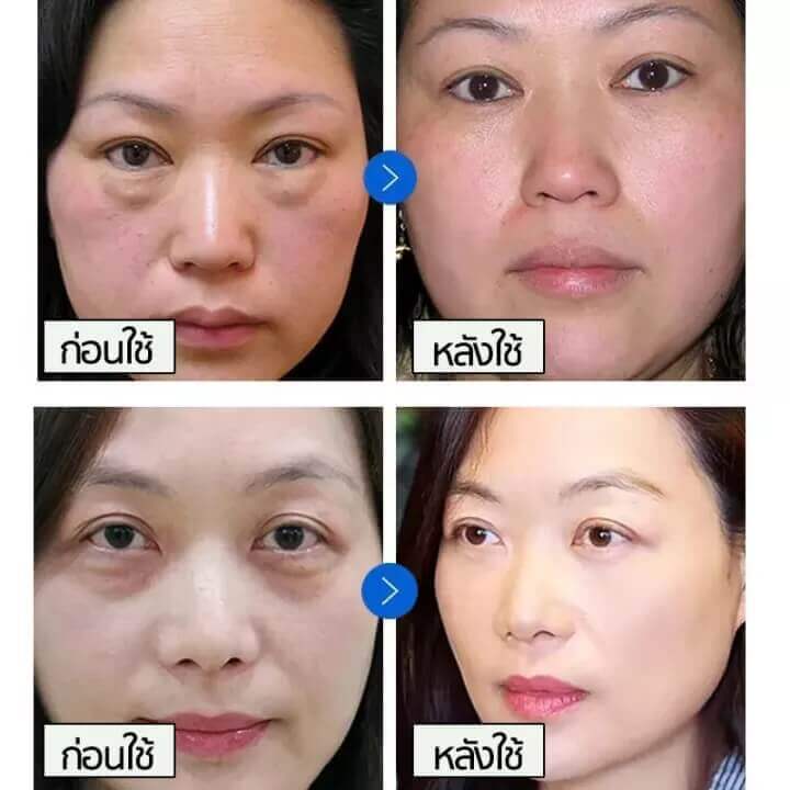 ครีมลดถุงใต้ตา-ครีมทาถุงใต้ตา-ครีมลบถุงใต้ตา-ครีมทาใต้ตาดำ-retinol-eye-cream-อายครีมเรตินอล-กระชับ-ยกกระชับ-อายครีมลดริ้วรอย-ลดบวมถุงใต้ตา-ขอบตาดำ-และอนุภาคไขมัน