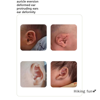 Hiking fun💕 อุปกรณ์แก้ไขหูเด็ก1.5ม. ม้วนซิลิโคนแก้ไขหูยื่นออกมาสำหรับเด็กทารกสติกเกอร์แก้ไขหูให้ถูกต้องสวยงามสำหรับเด็กอุปกรณ์ดูแลหู