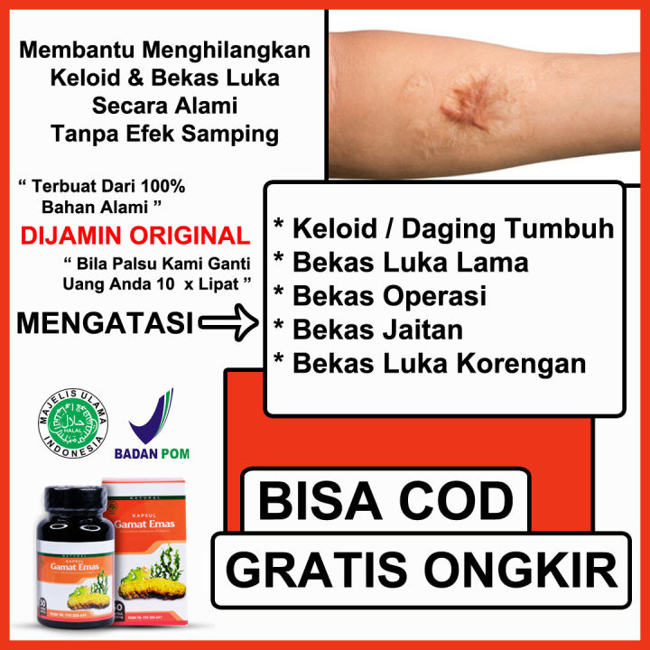 Kapsul Keloid Menahun Obat Daging Tumbuh Jadi Penghilang Bekas Luka