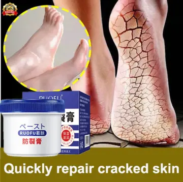 Repairing deals cracked heels