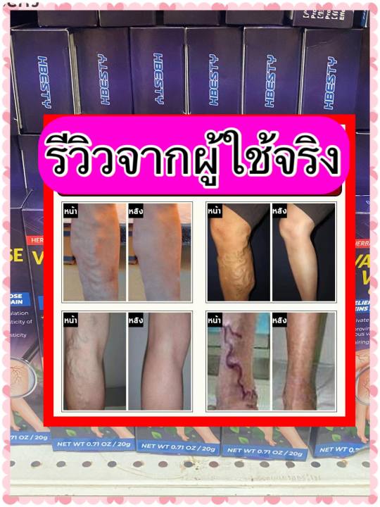 ส่งไวส่งฟรี-hebety-ครีมสมุนไพรรักษาเส้นเลือดขอด-ครีมเส้นเลือดขอด-รักษาเส้นเลือดขอด-ขนาด-20กรัม