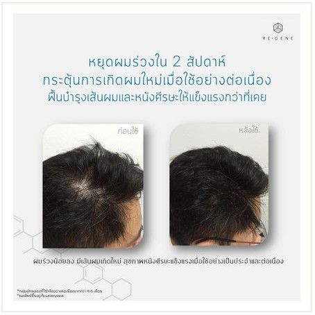 รีจีน-regene-แชมพูสำหรับลดผมร่วง-หัวล้าน-ผมบาง-เห็นผลจริง