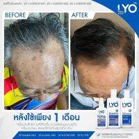 เซรั่มปลูกผม 1 เซต  ?? ชุดดูแลผมครบเซต LYO ไลโอ ผลิตภัณฑ์ของหนุ่ม กรรชัย ป้องกัน ผมร่วง ผมบาง ผมหงอก แชมพู + ครีมนวด+โทนิค