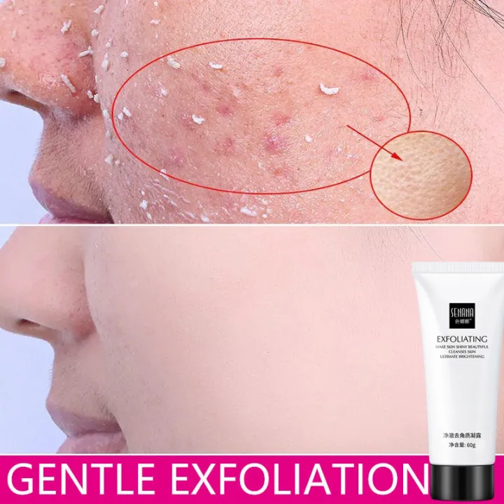 60ML SENANA Skin Care Face Exfoliating Gel Acne Blackhead Treatment