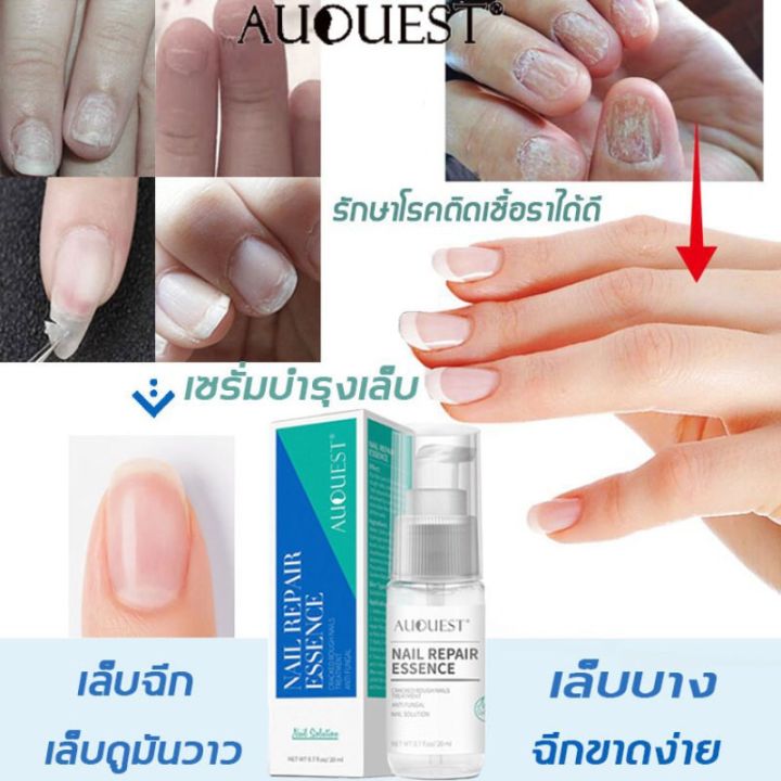 auquest-เซรั่มรักษาเล็บ-น้ำมันบำรุงเล็บ-เอ็สเซ้นซ่อมแซมเล็บเสีย-ยาทาเล็บ-รักษาโรคเชื้อราที่เล็บ-เซรั่มรักษาเล็บพัง-ยาทาแก้เชื้อราที่เล็บ-บำรุงเล็บ-น้ำยารักษาเล็บ-รักษาเล็บเสีย-น้ำยาล้างเล็บ-เซรั่มบำรุ