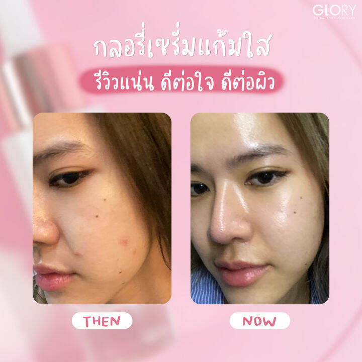 ส่งฟรี-เซรั่มกลอรี่-เซรั่มแก้มใส-glory-serum-pauseile-ลดรอยสิว-จางไวมาก-สิว-ปรับผิวเนียน-ขาวใส