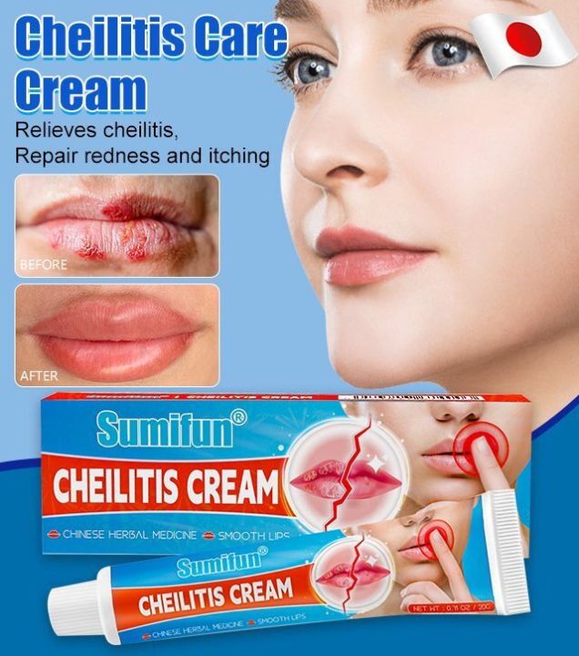 Usmartt Cheilitis Cream Lip Care Skin Topical Cream | Lazada PH