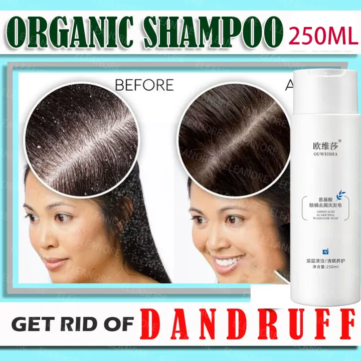 Anti Dandruff Shampoo Fast Effective Anti Dandruff Scalp Treatment