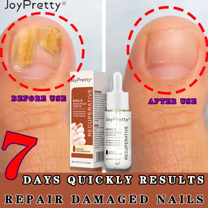 【Painless and quick treatment】Nail Repair Liquid Treatment of