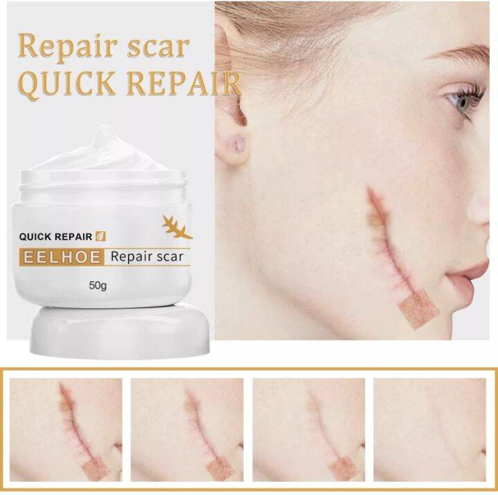 【7 Days 100% Effective】EELHOE Scar Remover for Old Scar on Face and ...