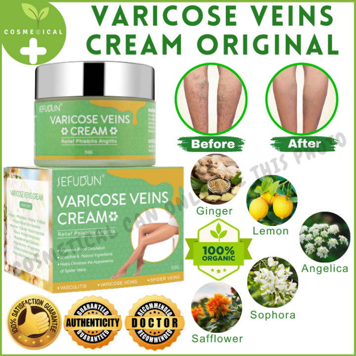 Varicose Vein Cream Remover Pain Reliever SEFUDUN Varicose Veins ...