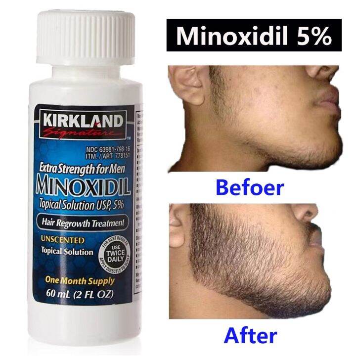 1 bottle of Kirkland minoxidil 5 topical solution hair growth liquid ...