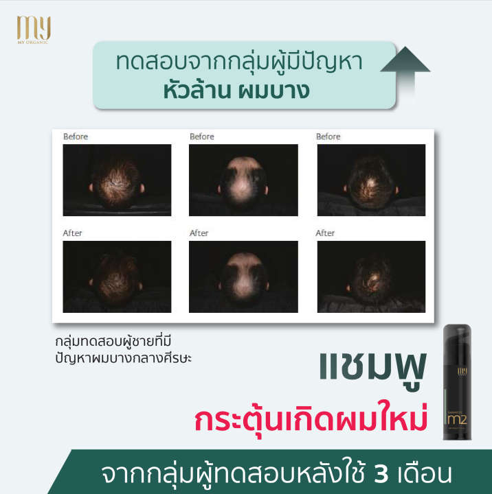 แชมพู-ผมร่วง-ผมบาง-กำจัดรังแค-m2-แบรนด์-my-organic