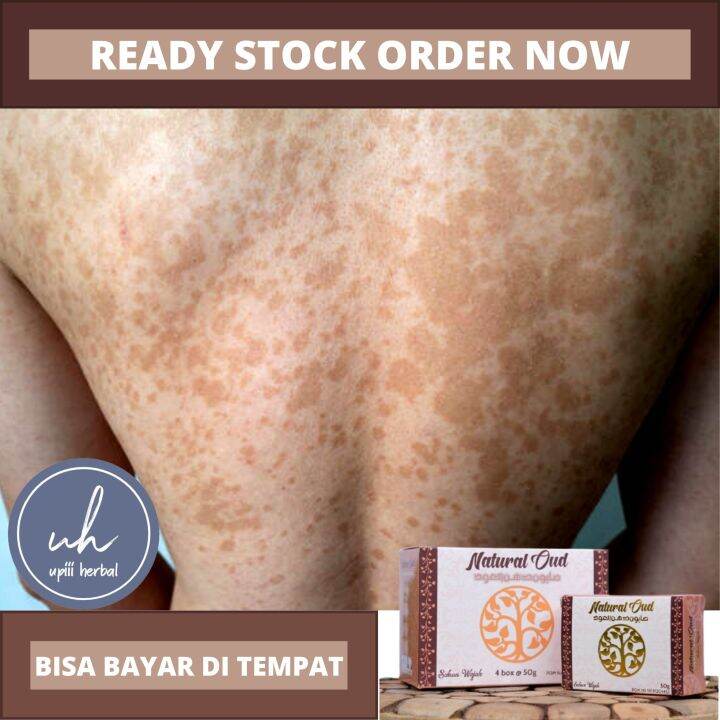 Sabun Pehilang Panu, Sabun Untuk Panu Di Kulit, Sabun Atasi Infeksi