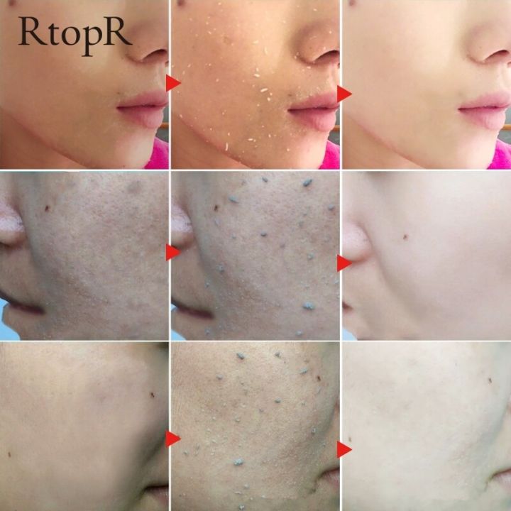 rtopr-facial-exfoliating-cream-เจลมะม่วงขัดผิว-ฮิตใน-tiktok-rtopr-mango-เจลผลัดเซลล์-เจลขัดผิว-เจลขัดผิวหน้า-ครีมสครับผิวมะม่วง-ครีมขัดผิว