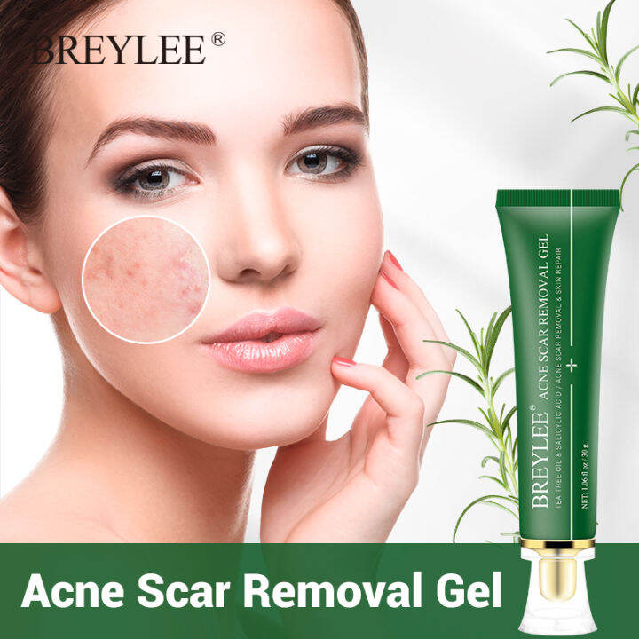 【100 authentic】Acne Pimple Scar Removal Stretch Marks Pigmentation Acne Treatment Essence Fades