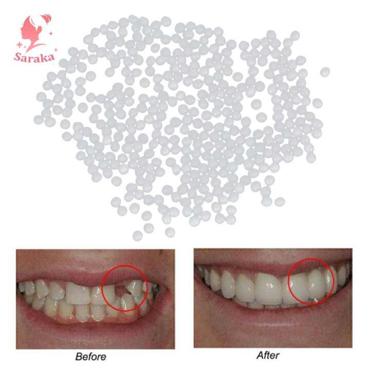 Saraka Thermal Beads Teeth Veneer Moldable Denture Temporary Tooth