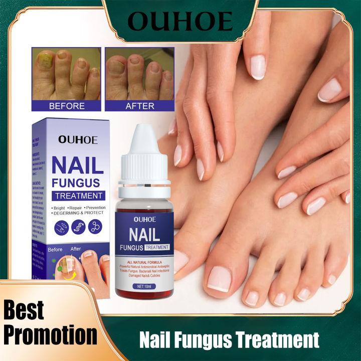 Natural Nail Fungus Treatment & Remedy for Your Symptoms
