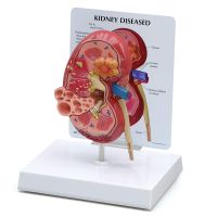 Kidney Pathologies Model Human Body Anatomy Replica of Diseased Kidney for Doctors Office Educational Tool GPI Anatomicals