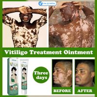 Herbal Extract Vitiligo Ointment Remove Ringworm White Spot Removal Skin Vitiligo Eliminate Vitiligo Treatment Cream