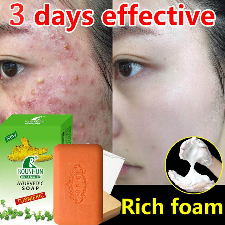 Turmeric Soap Original & 100% Authentic Whitening Soap, Acne Treatment ...