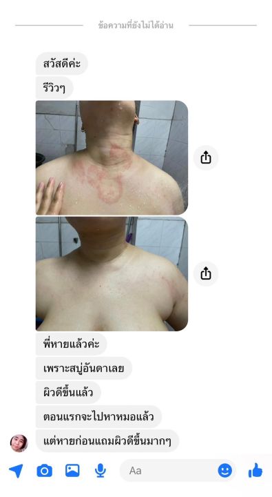 พร้อมส่ง-สบู่โสมน้ำผึ้ง-anda-โรคสะเก็ดเงิน-โรคผิวหนังคับ-กลากเกลื้อน-เชื้อรา-น้ำเหลืองเสีย-จบที่ก้อนเดียว-หายขาด