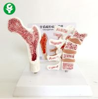 Human femoral osteoporosis model leg bone anatomical surface lumbar spine specimen cut lesions model