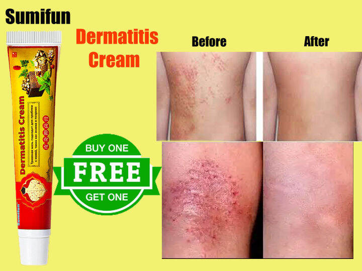 Buy One Get One Free Sumifun Dermatitis Cream Skin Rash Ointment Natural Chinese Herbal 9948