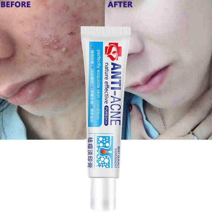 Hyaluronic Acid Acne Cream Effectively Removes Acne Fades Acne Marks