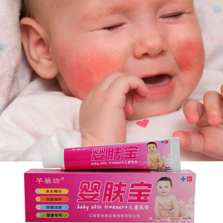 Eczema Cream baby krim gatal antifungal cream Nappy cream baby