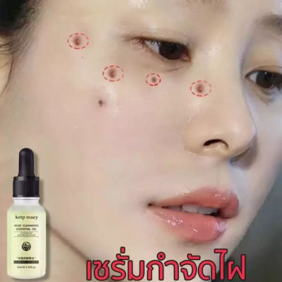 Ketpmaey ครีมทาฝ้า 30ml ลดฝ้ากระที่ฝังลึก กำจัดฝ้า จุดด่างดำ ฝ้า กระ กระจ่างใสผิว ลดเม็ดสีเมลานิน ครีมทาฝ้าลึก ครีมหน้าขาวใส ครีมทาฝ้ากระ ครีมฝ้ากระ ครีมทาหน้าขาว ครีมกระไวท์เทนนิ่ง ไวท์เทนนิ่งครีม ครีมไวท์เทนนิ่ง บำรุงผิวหน้า ครีมรักษาฝ้า ครีมแก้ฝ้าลึก