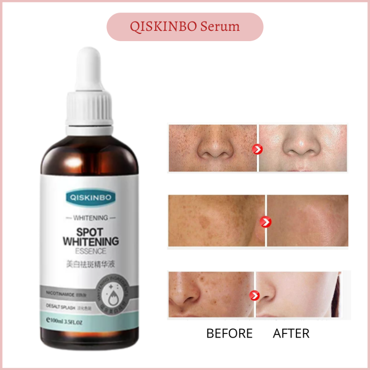 QISKINBO melasma and pekas remover serum, melasma removal cream ...