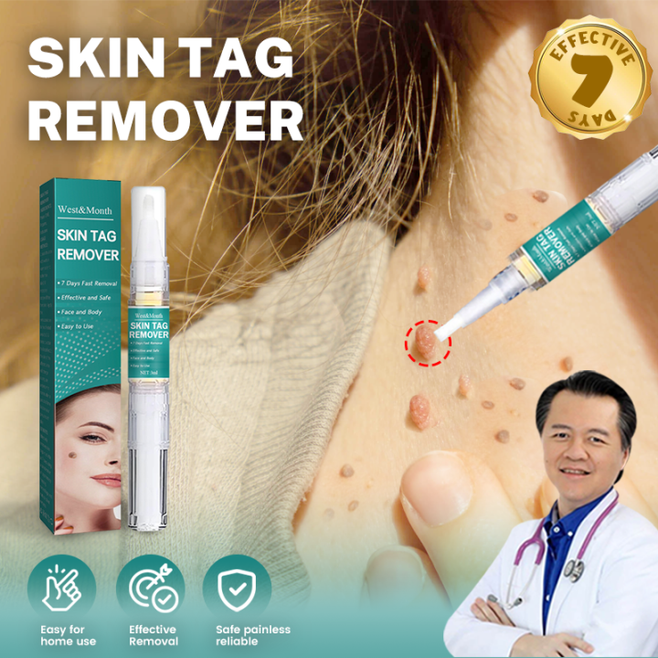 Warts Remover Original Watson Warts Removal Mole And Warts Remover Skin ...