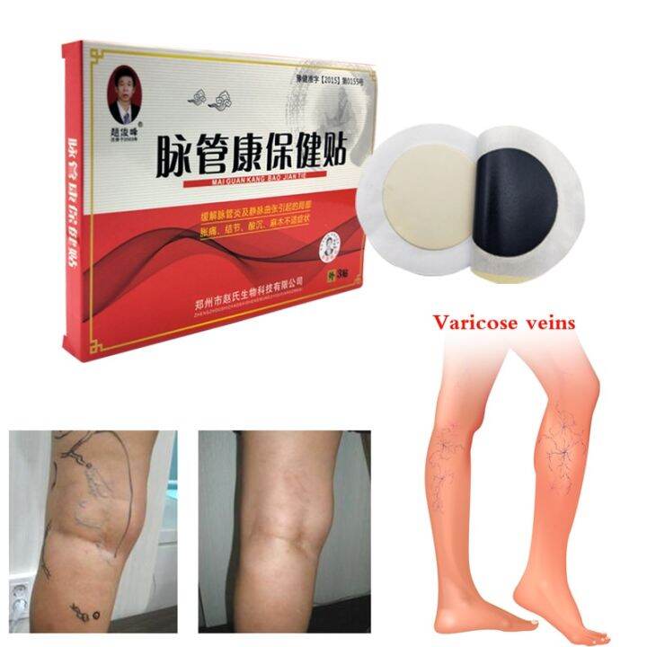 【HOT】 IDC MALL 4pcs Spider Veins Varicose Treatment Plaster Varicose Veins Cure Patch Vasculitis